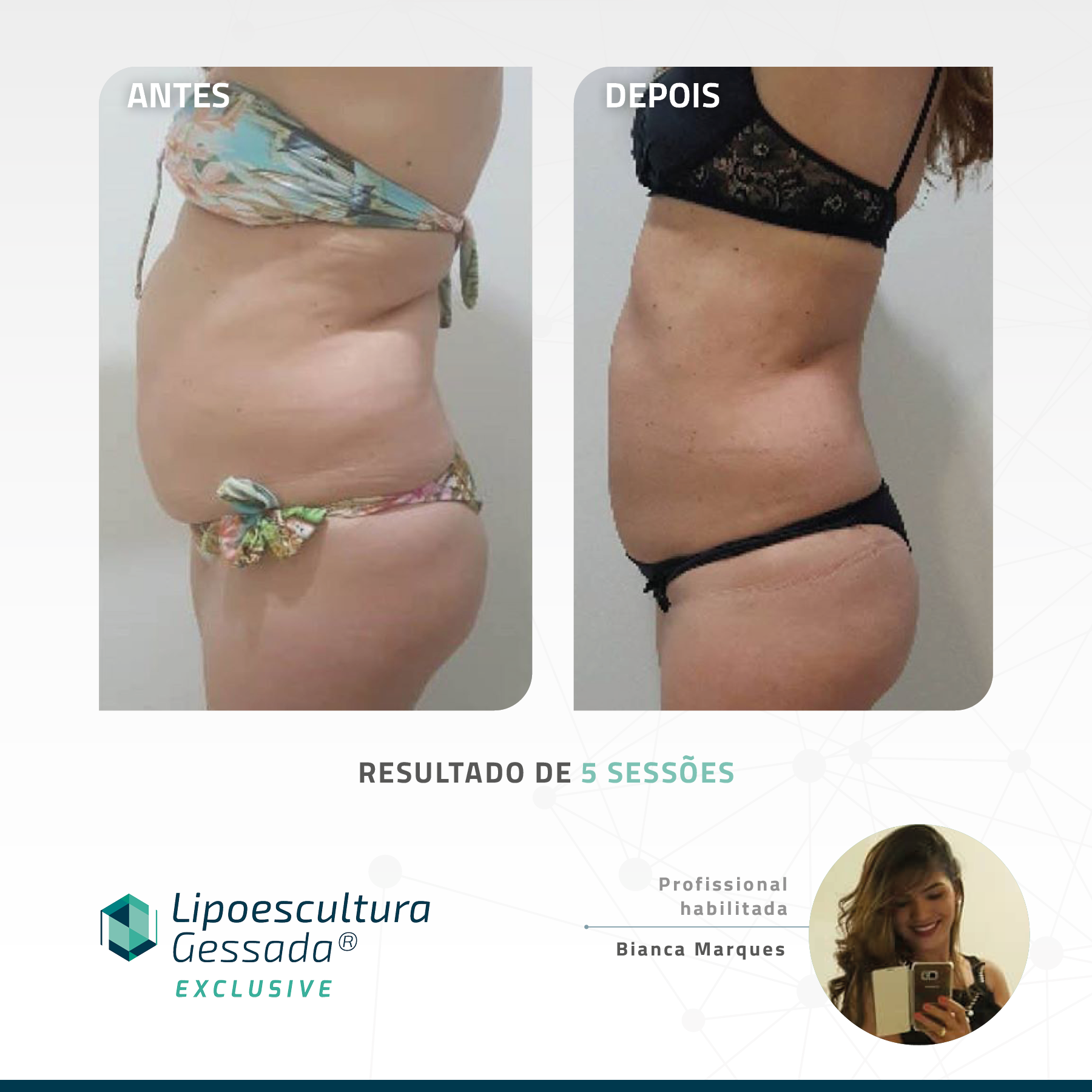 Antes e depois com a Lipoescultura Gessada