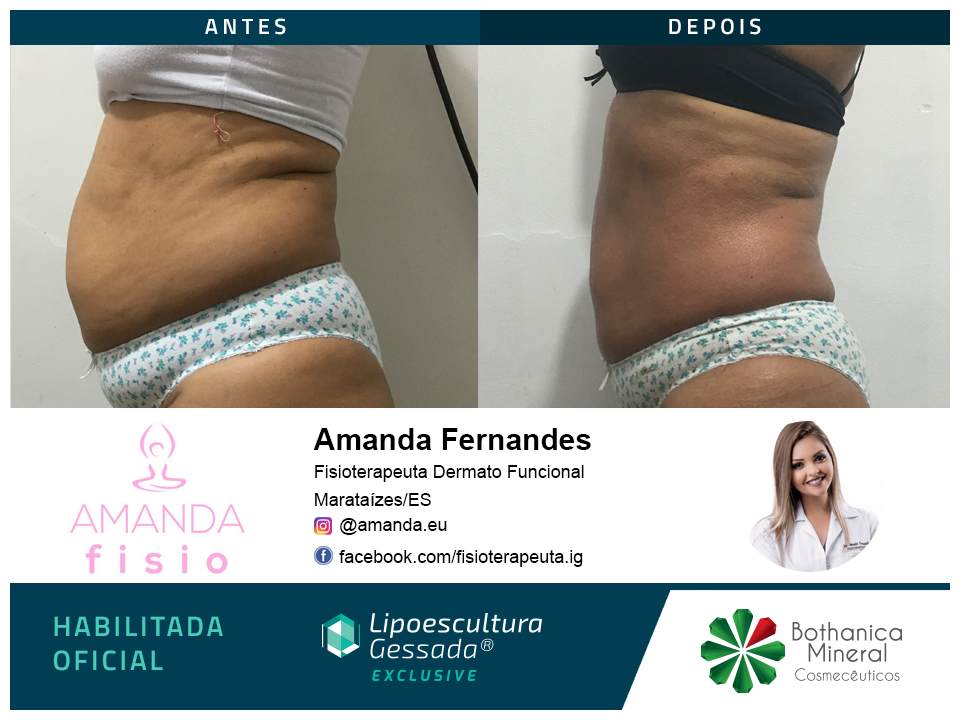 Antes e depois com a Lipoescultura Gessada