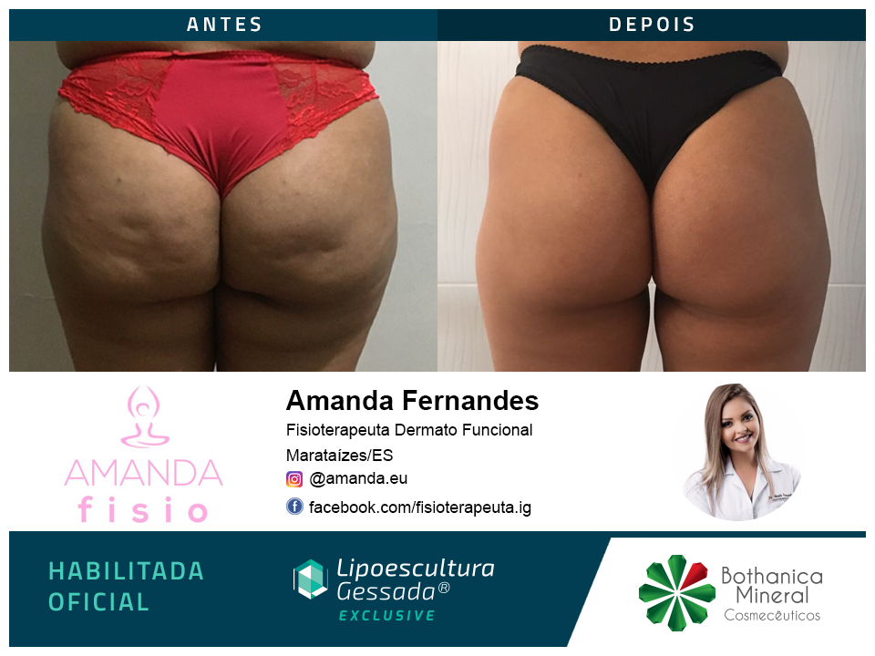 Antes e depois com a Lipoescultura Gessada