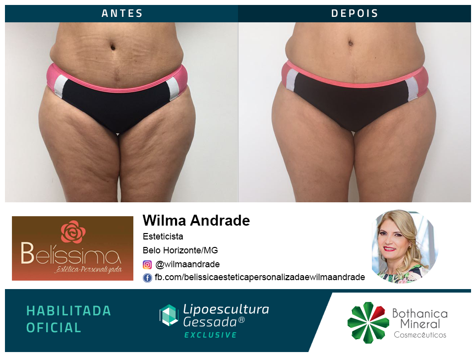 Antes e depois com a Lipoescultura Gessada