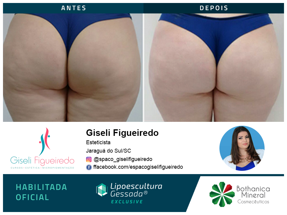 Antes e depois com a Lipoescultura Gessada
