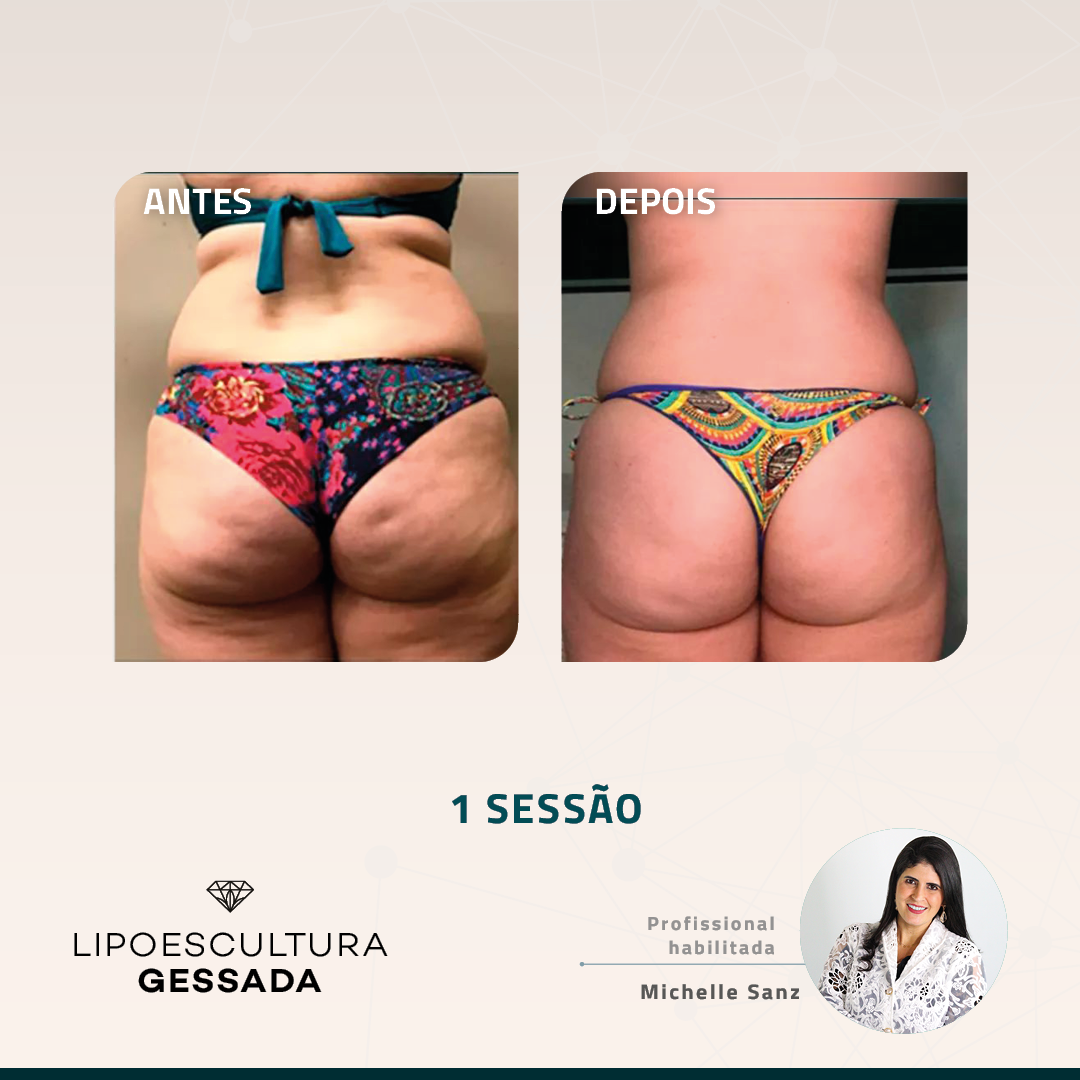Antes e depois com a Lipoescultura Gessada
