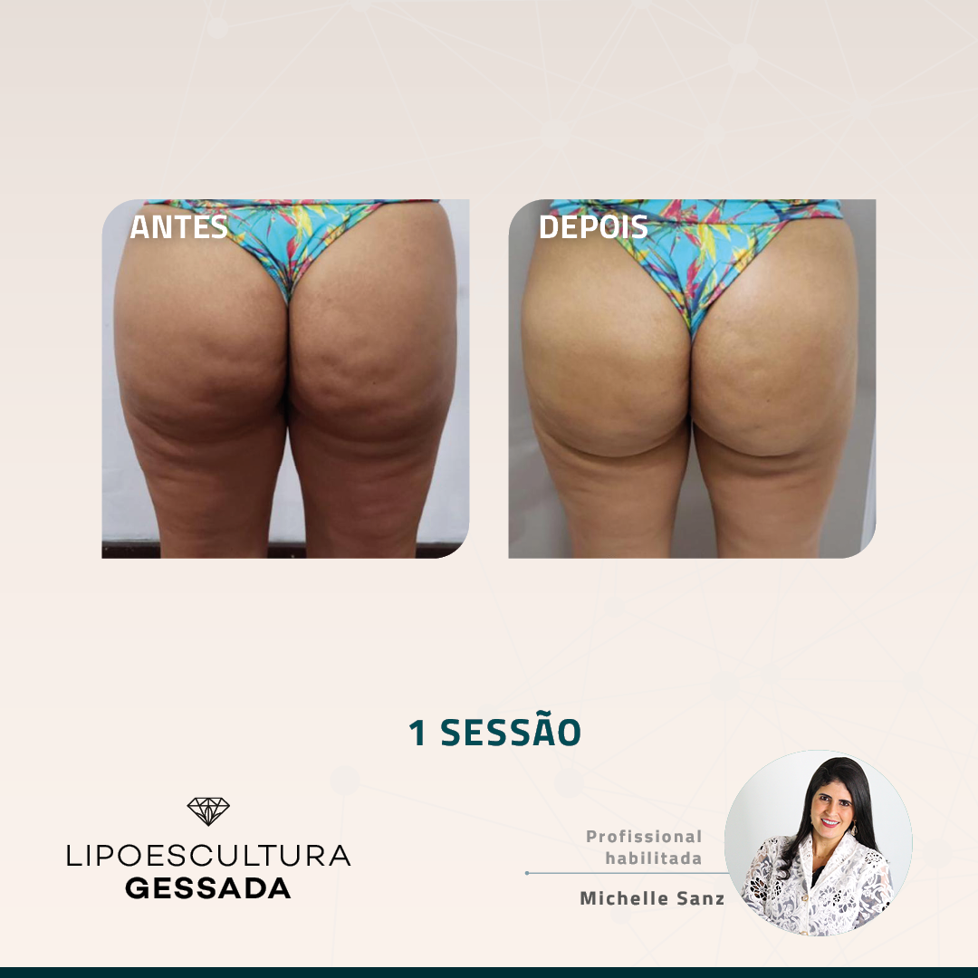 Antes e depois com a Lipoescultura Gessada