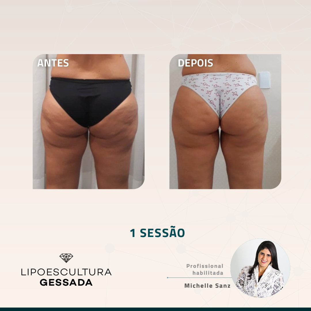 Antes e depois com a Lipoescultura Gessada