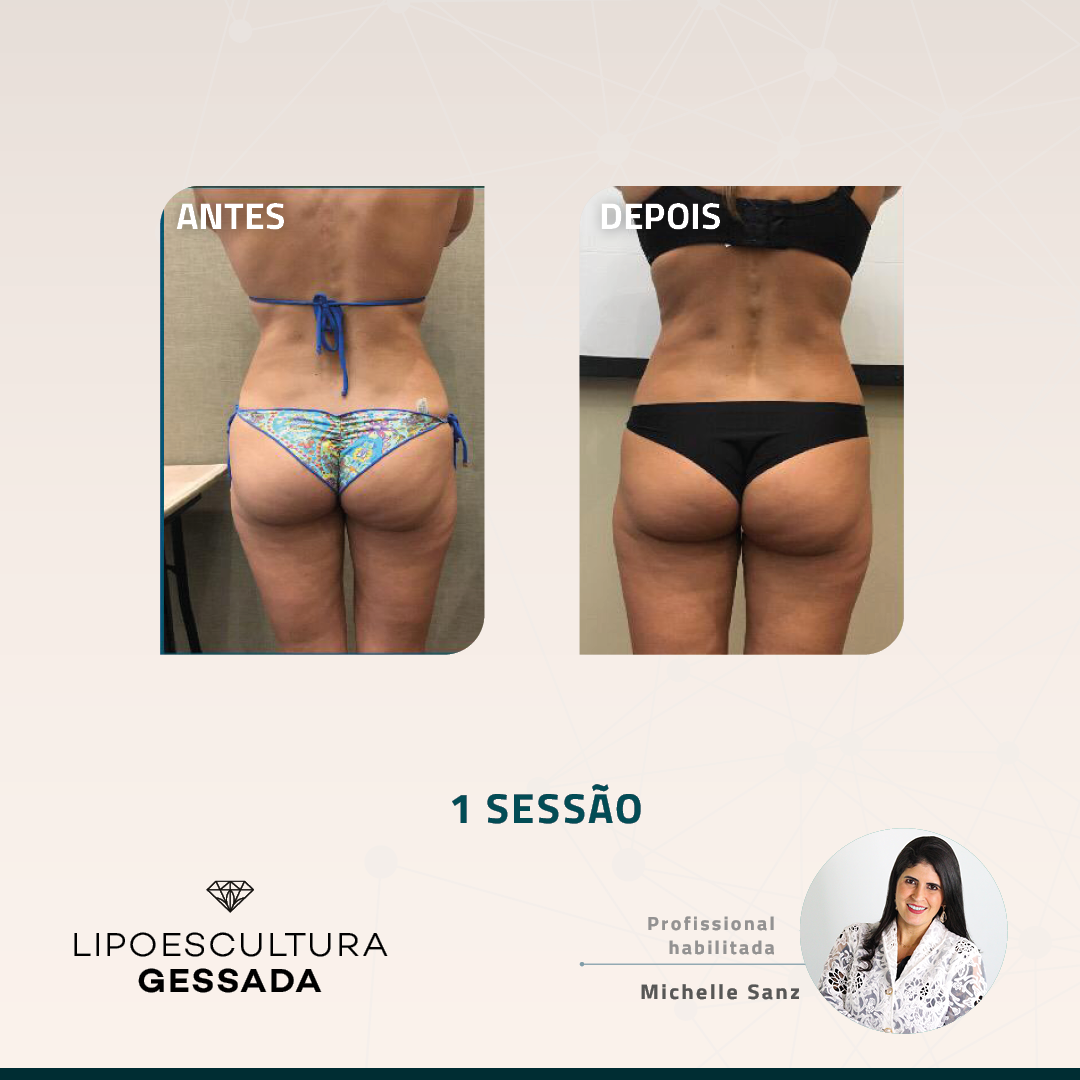 Antes e depois com a Lipoescultura Gessada