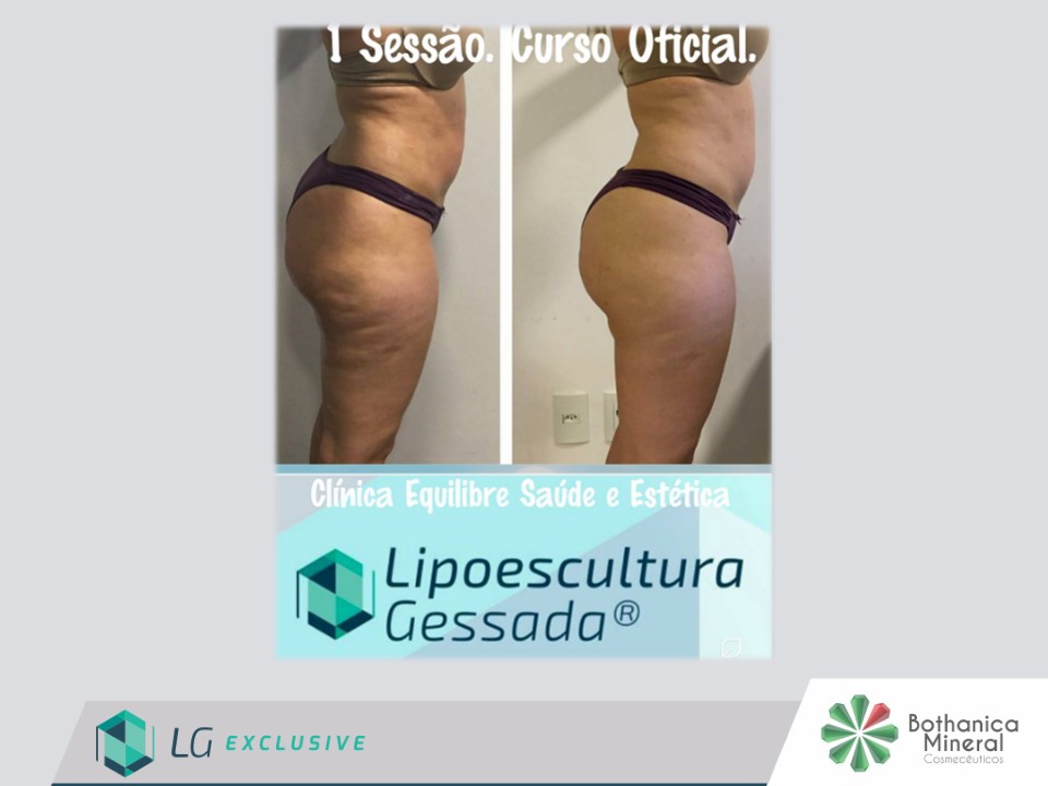 Antes e depois com a Lipoescultura Gessada