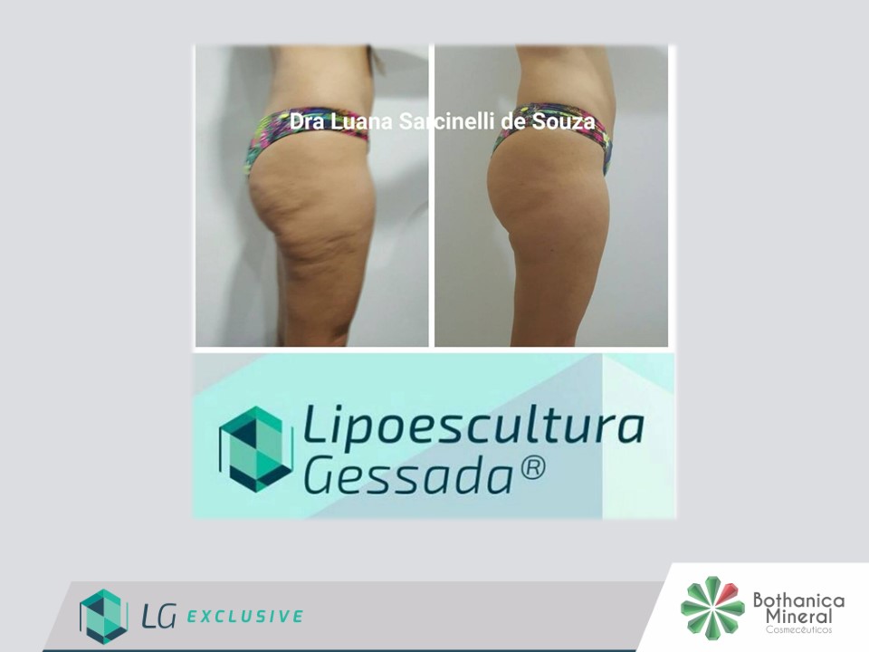 Antes e depois com a Lipoescultura Gessada