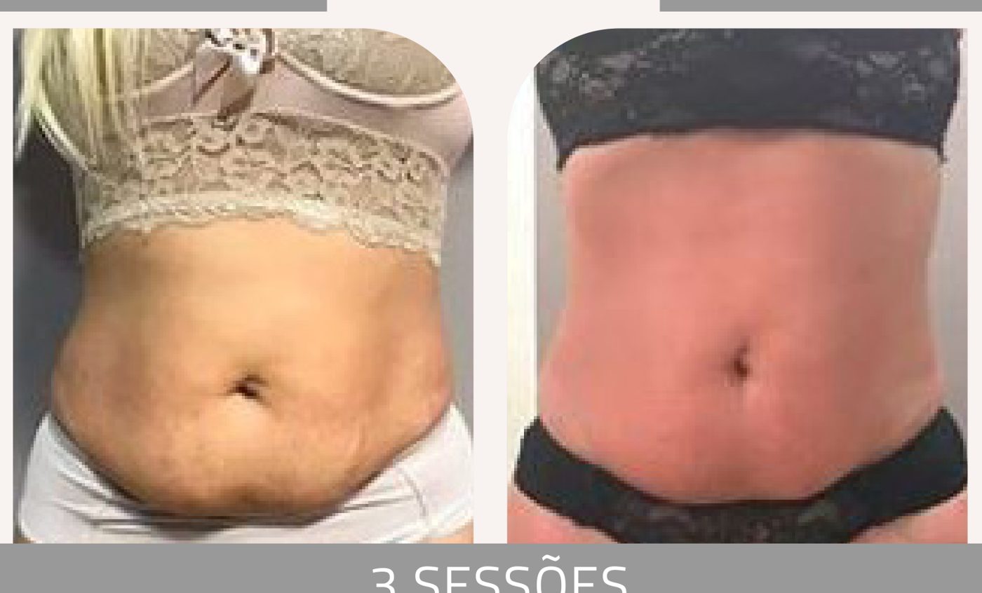 Antes e depois com a Lipoescultura Gessada — Apresentação Oficial Bothanica Mineral