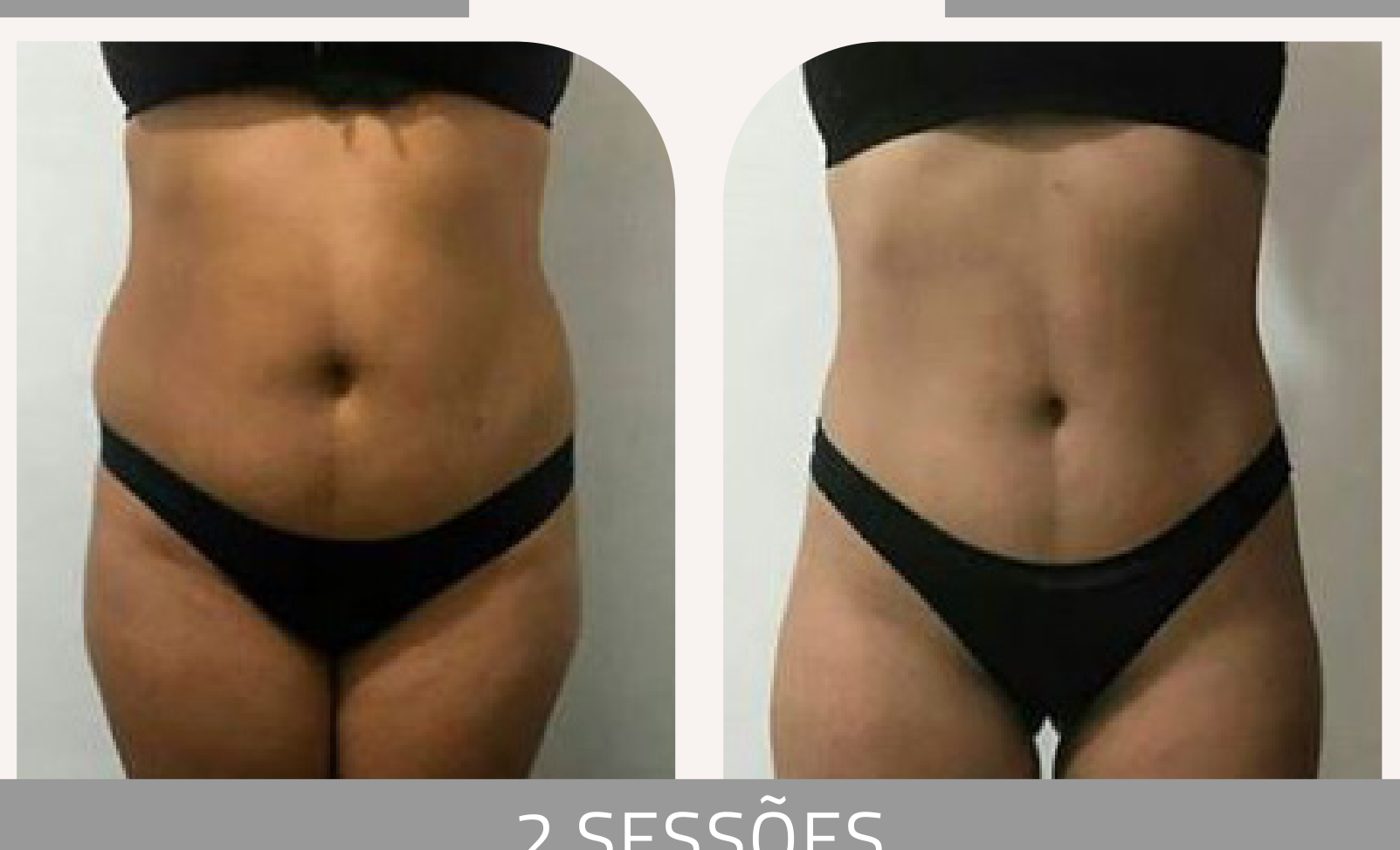 Antes e depois com a Lipoescultura Gessada — Apresentação Oficial Bothanica Mineral