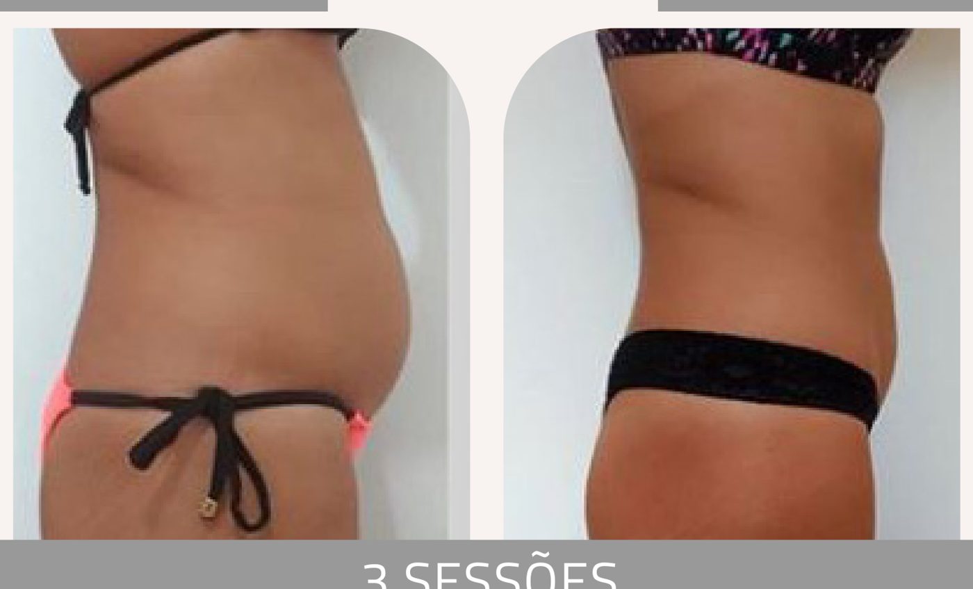 Antes e depois com a Lipoescultura Gessada — Apresentação Oficial Bothanica Mineral