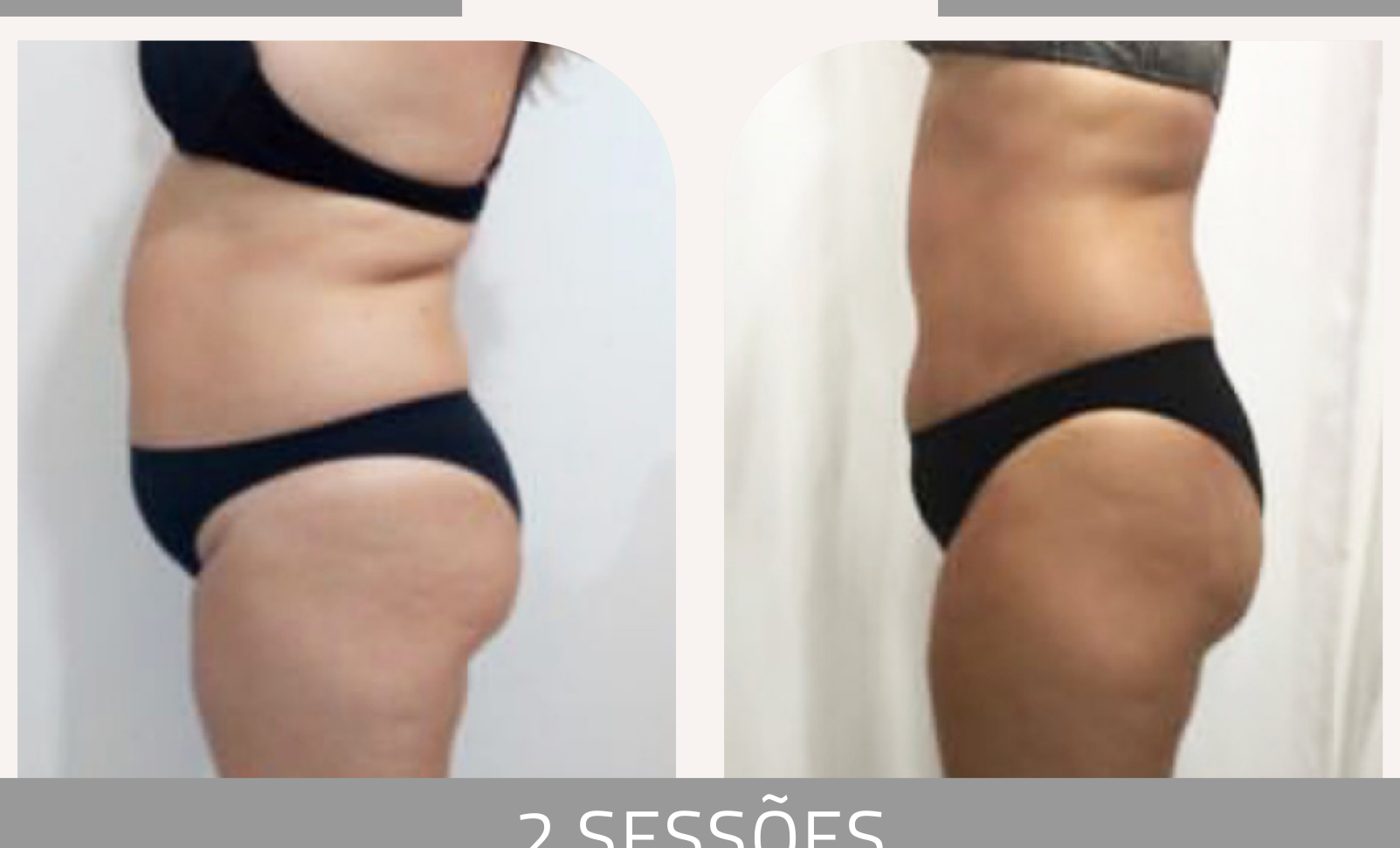 Antes e depois com a Lipoescultura Gessada — Apresentação Oficial Bothanica Mineral