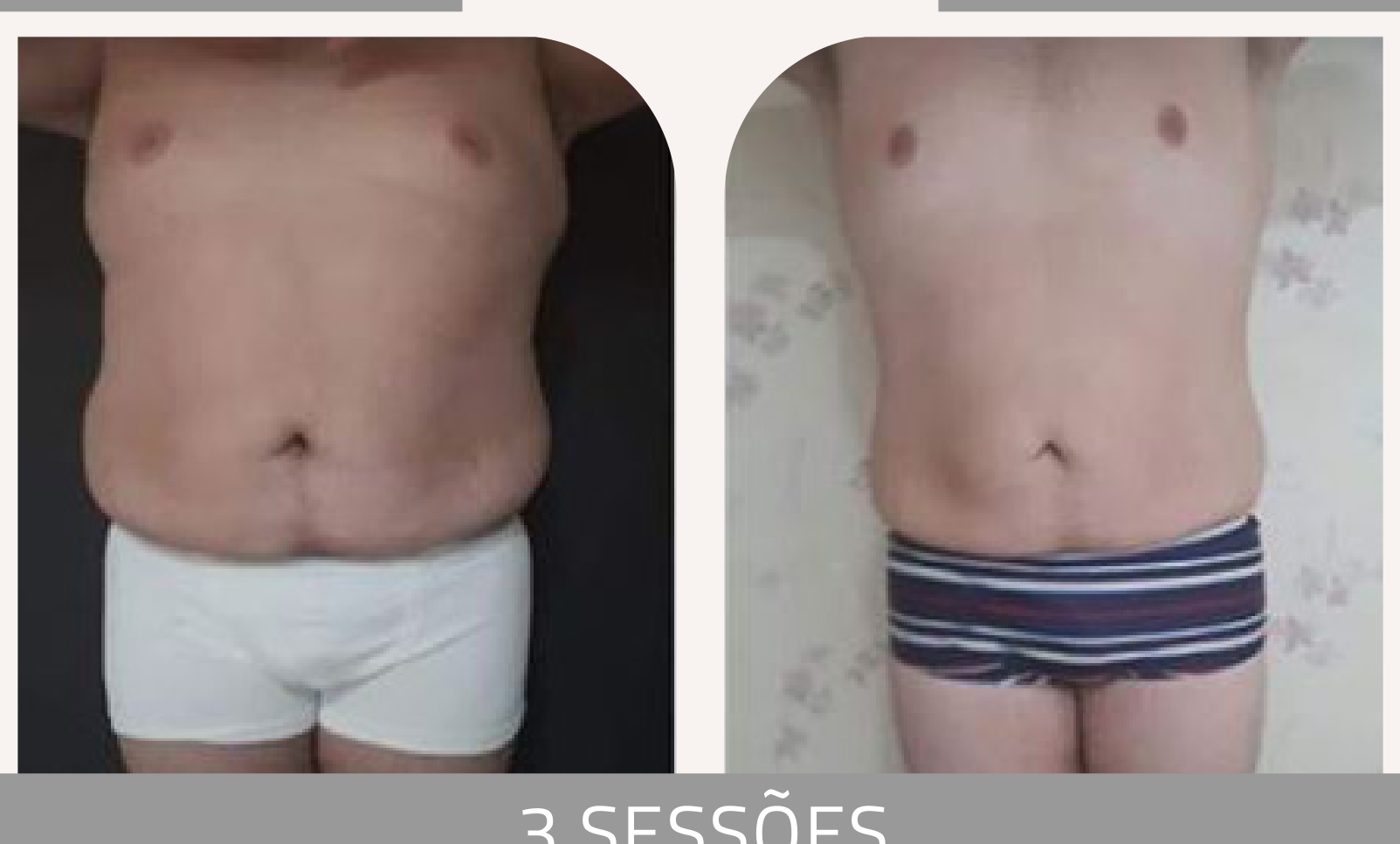 Antes e depois com a Lipoescultura Gessada — Apresentação Oficial Bothanica Mineral