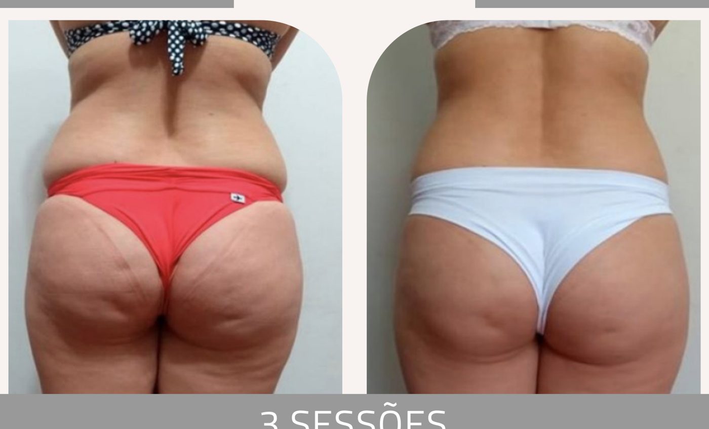 Antes e depois com a Lipoescultura Gessada — Apresentação Oficial Bothanica Mineral