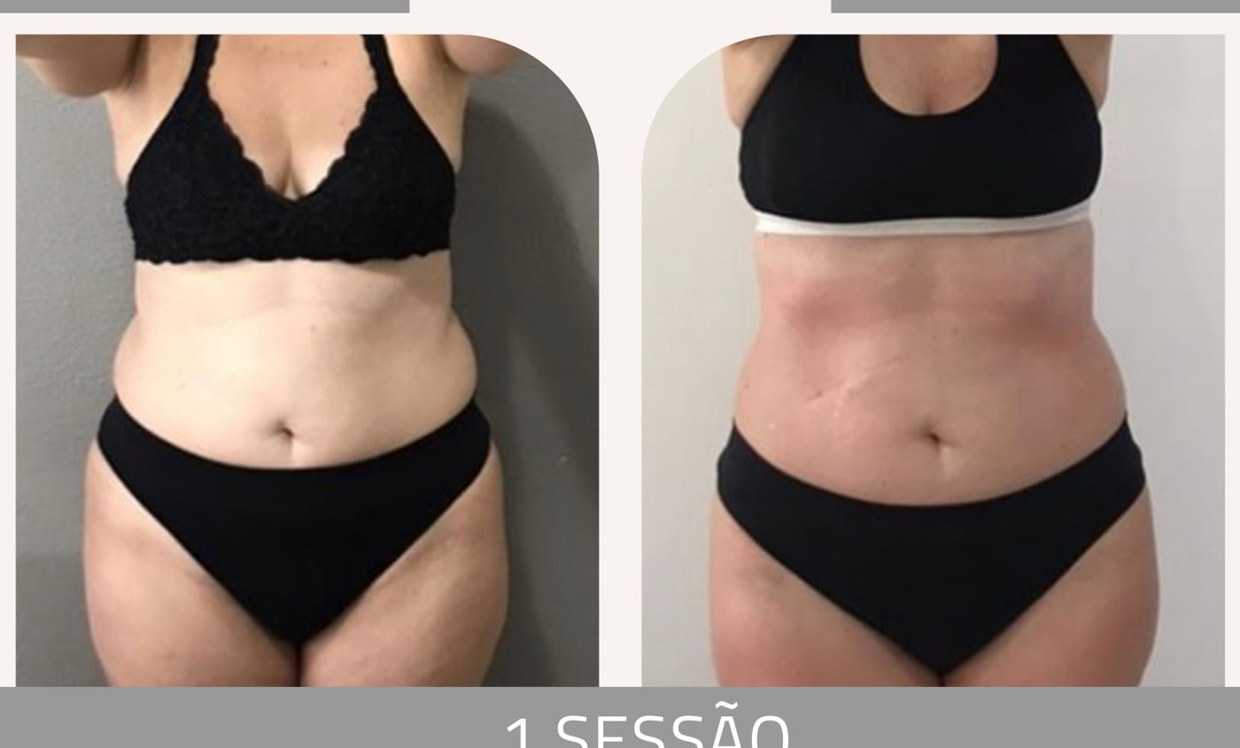 Antes e depois com a Lipoescultura Gessada — Apresentação Oficial Bothanica Mineral