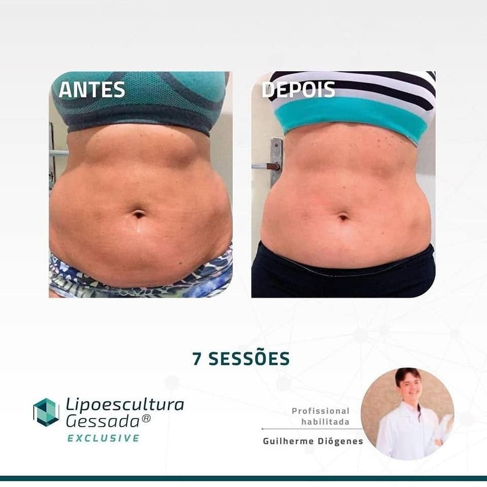 Antes e depois com a Lipoescultura Gessada — resultado de 7 sessões