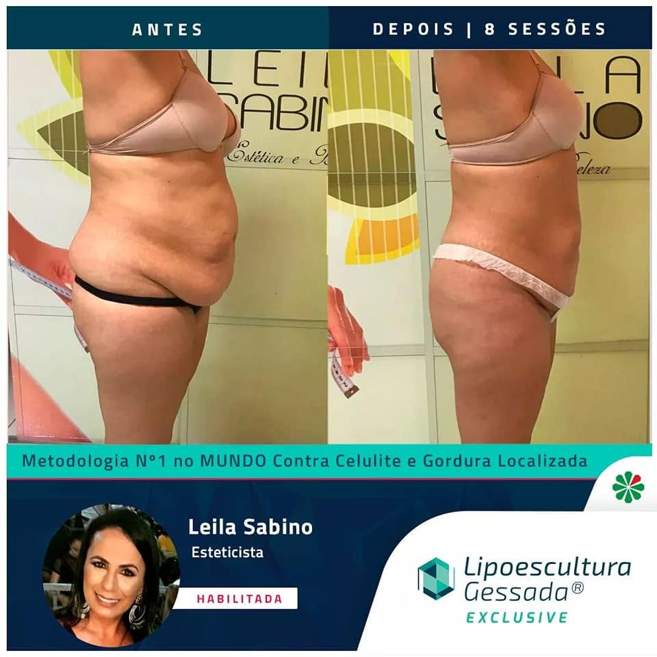 Antes e depois com a Lipoescultura Gessada — resultado de 8 sessões